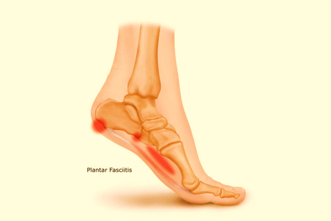 plantar fasciitis