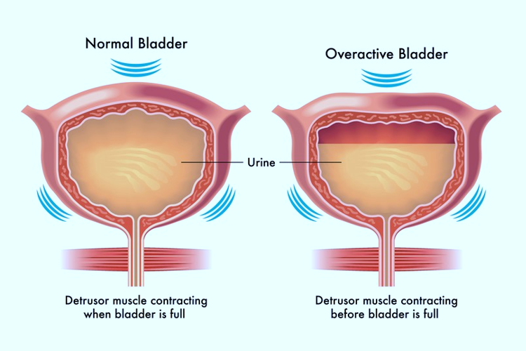 overactive bladder syndrome